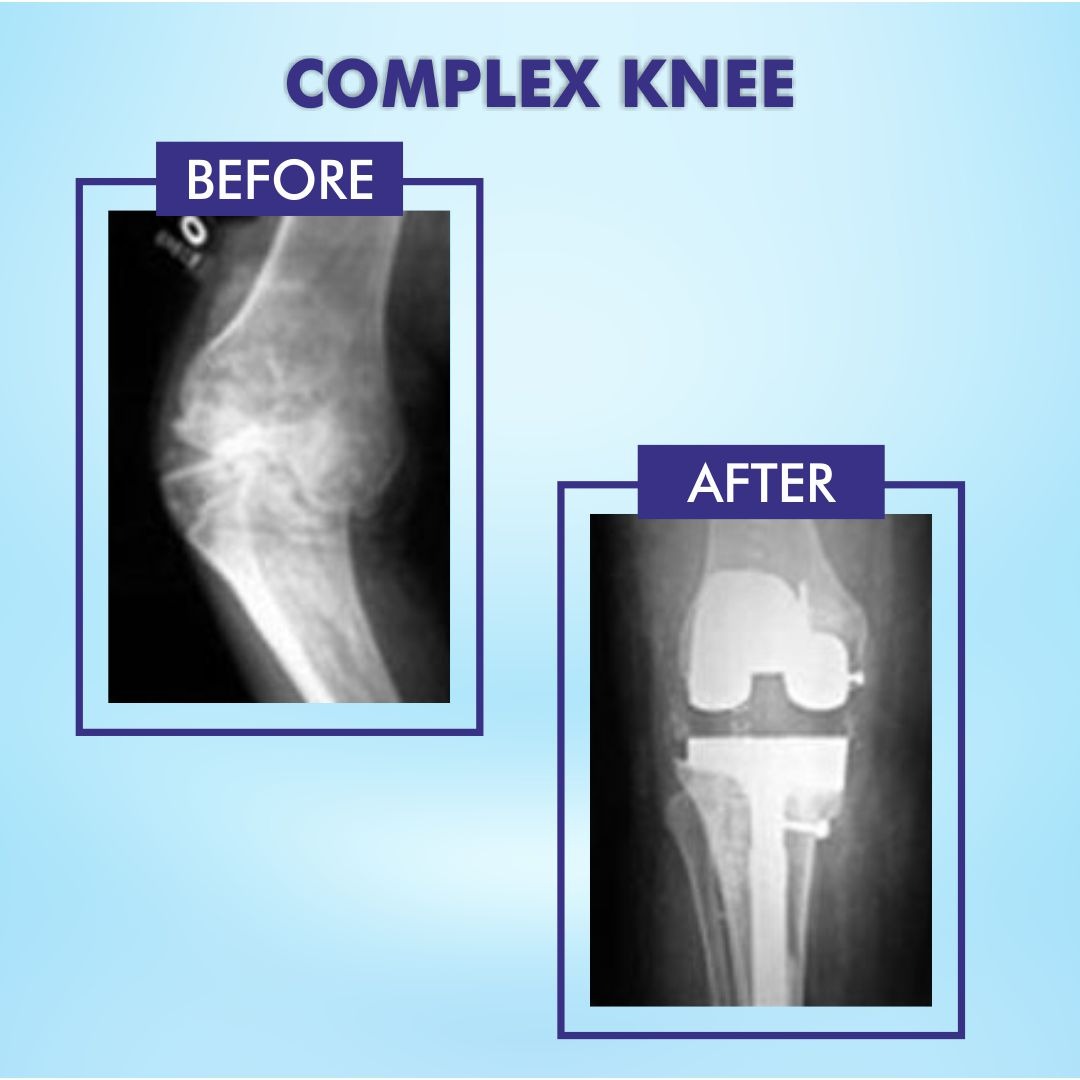 Complex Knee