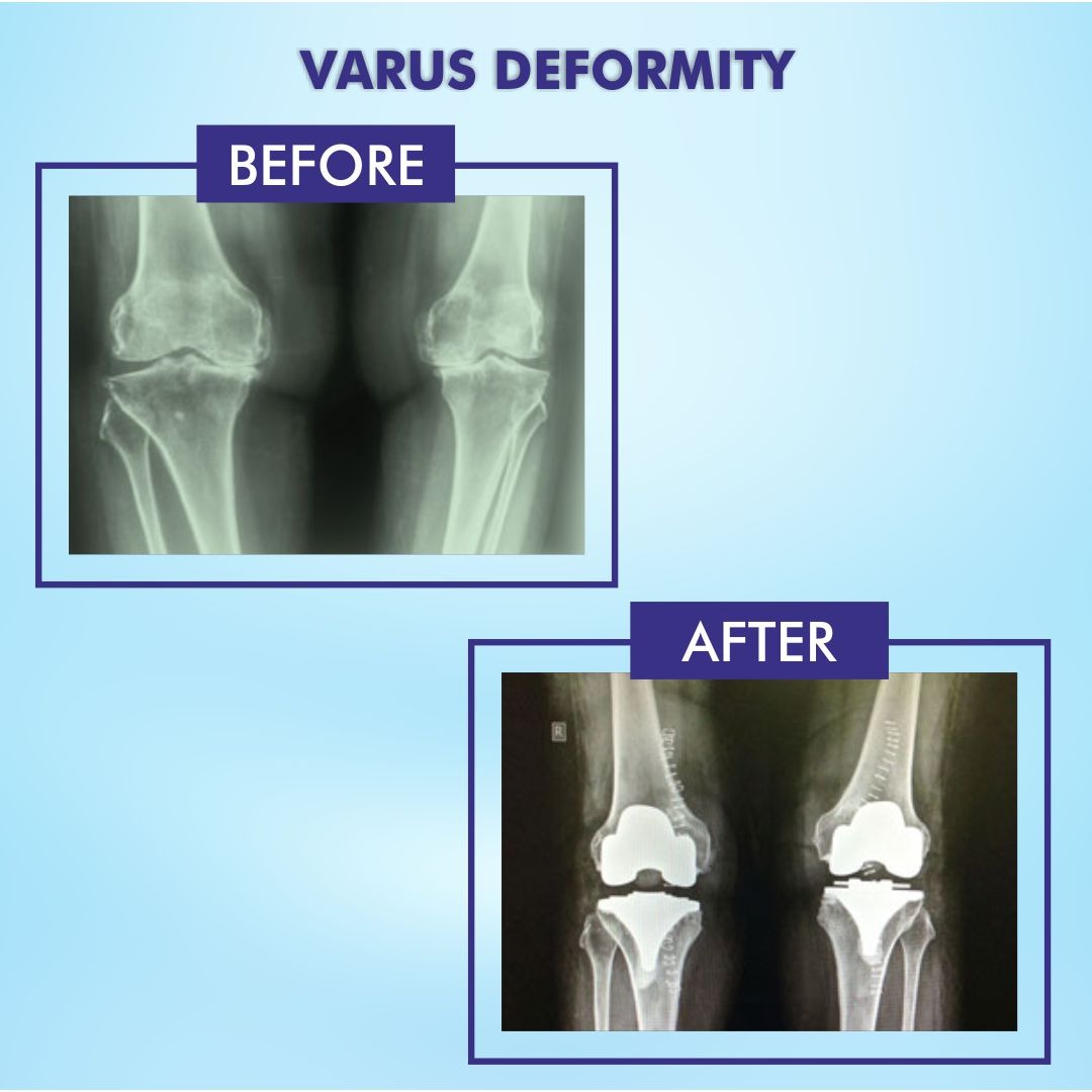 Varus Deformity