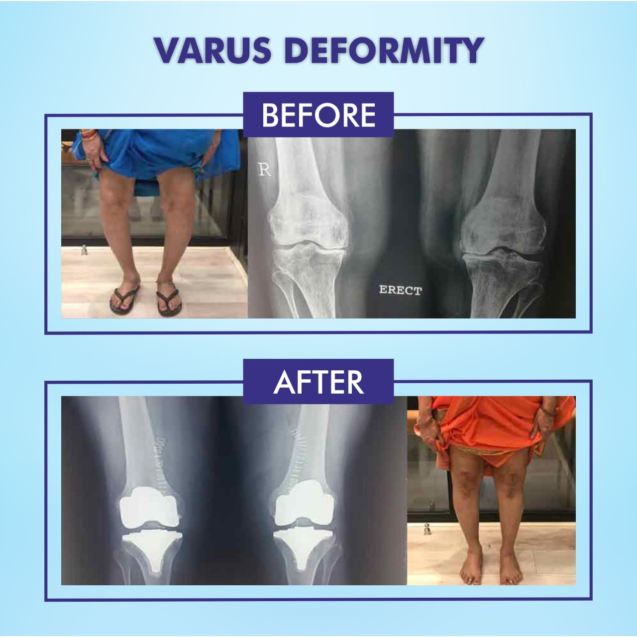 Varus deformity