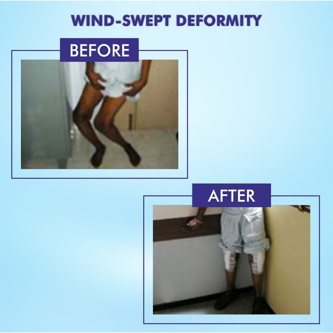 Wind-Sweft Deformity