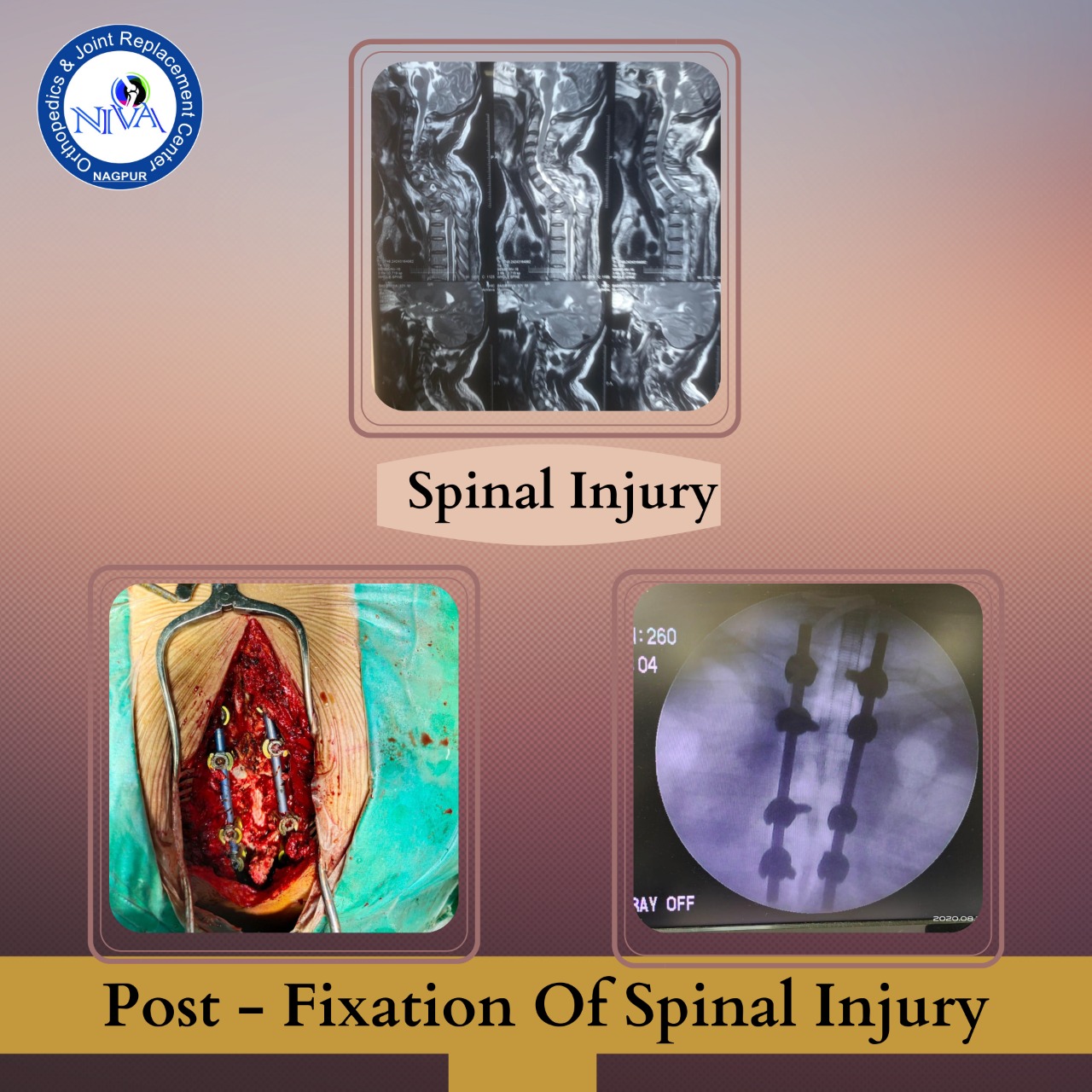 Fixation of Spinel Injury