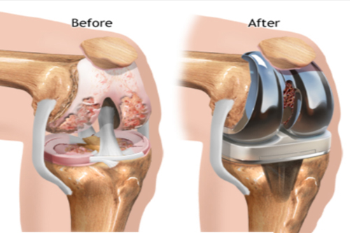 knee replacement after surgery and before surgery image explain