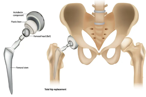 total hip replacement diagram explain